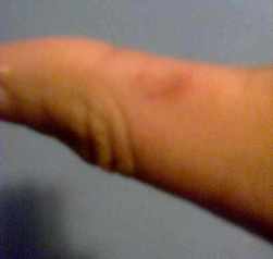 lesion dedo 2