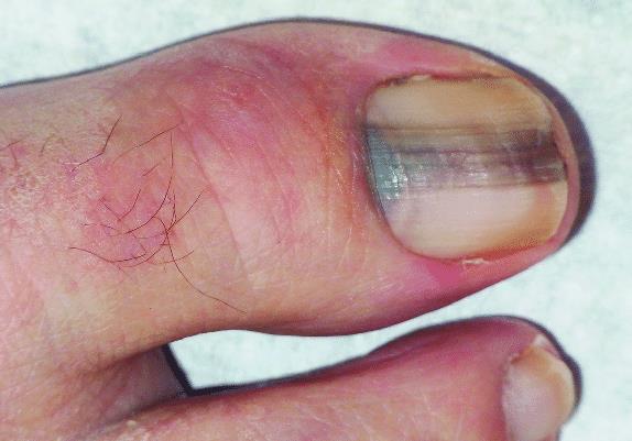 Subungual melanoma big toe in a 62 y o man researchgate
