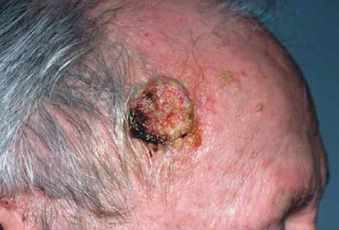 cancer piel cabeza medscape
