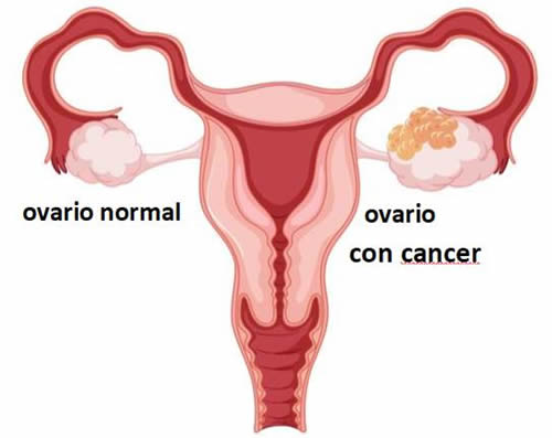 cancer de ovario 2