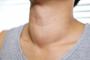 cancer de tiroides