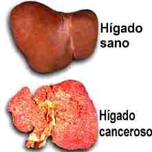 cancer hepatico