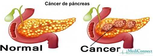 cancer pancreas