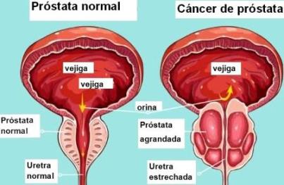 cancer prostata 2