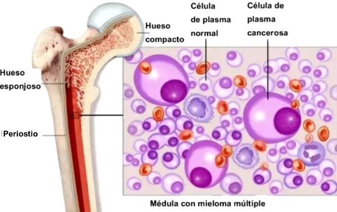 mieloma multiple medula US Dpt Health