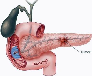 pancreas tumor