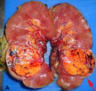 rinones tumores cancer