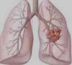 tumor pulmon