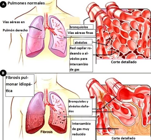 fibrosis pulmonar normal