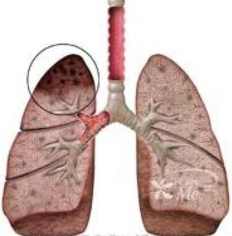 pulmon tbc