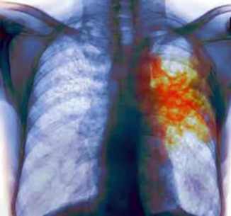 rx pulmones tuberculosis