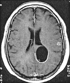 Cisticercosis cerebro Stanford