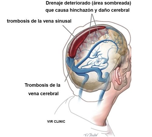 Trombosis del seno venoso cerebral Vir clinic