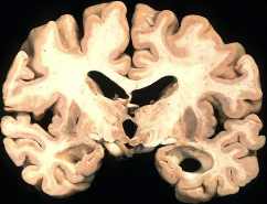 cerebro alzheimer 1