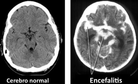cerebro normal y encefalitis HHV 6