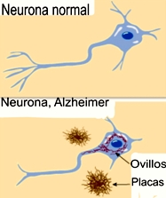 neurona alzheimer