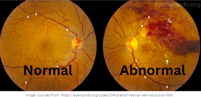 oclusion retinal vascular normal EyeRounds org