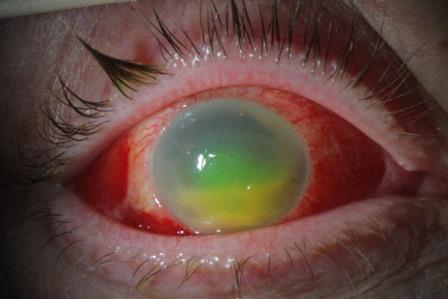ojo infeccion Lysteria monocytogenes