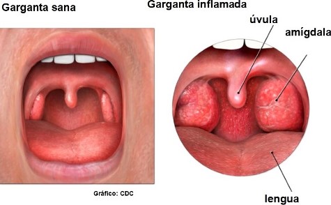 garganta sana inflamada CDC