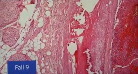 Reutlingen 31 caso severo linfocitos en pared vascular