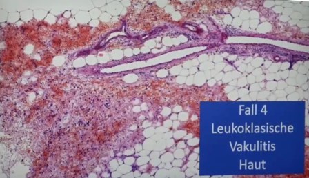 Reutlingen 36 piel perivasculitis con linfocitos y hematomas