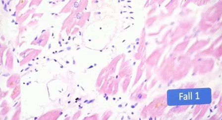 Reutlingen 3 fibra muscular dilatacion vasos linfocitos fibroblastos corazon
