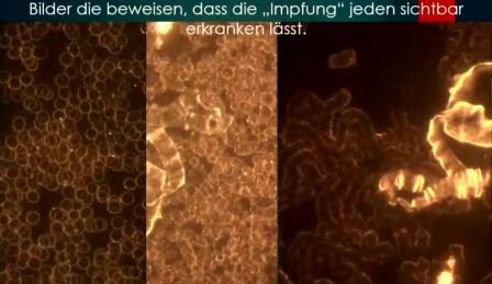 Reutlingen 56 microscopio campo oscuro glbulos rojos persona sana derecha despues vacunacion se ve aglutinacion