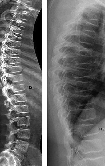 fractura vertebral adolescente European Journal of Endocrinology