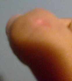 lesion dedo