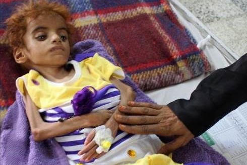 hambruna en Yemen 2