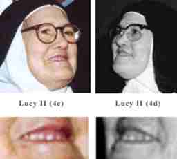 dientes Lucia II