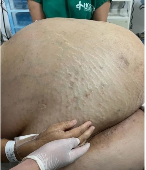 tumor 46 kg mujer Brasil 1
