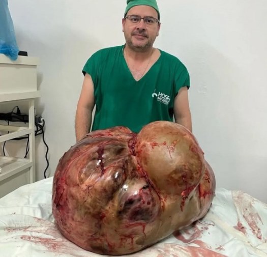 tumor 46 kg mujer Brasil 2