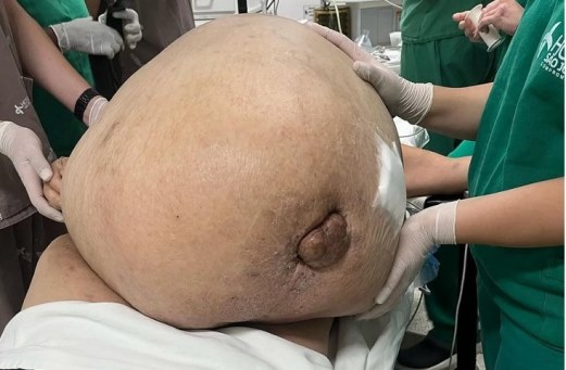 tumor 46 kg mujer Brasil 3