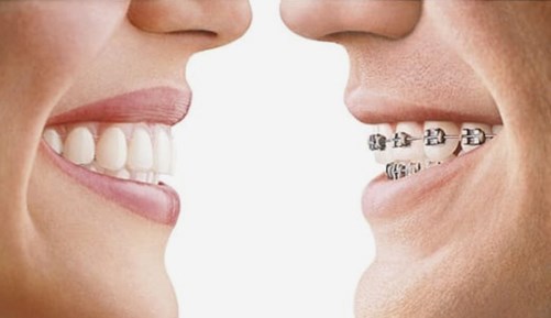 frenos dentales brackets 1