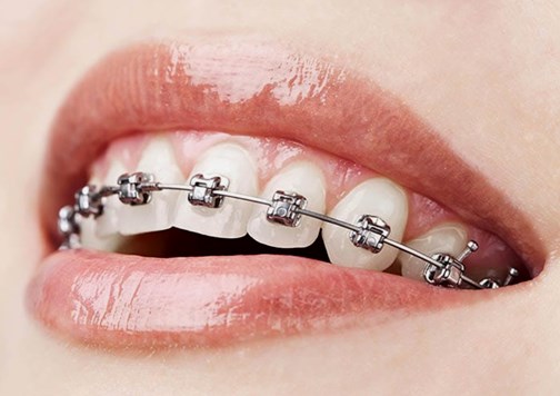 frenos dentales brackets 2