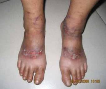 ulceras paraquat pies Spandidos